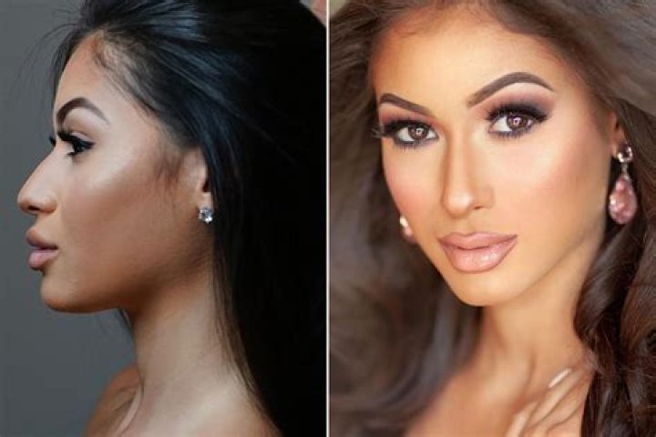 Before And After Her Nose Job