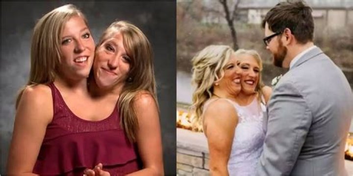 Conjoined Twins Who Found Love And Marriage