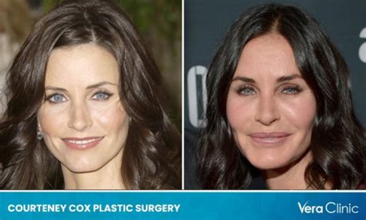 Courteney Cox's Botched Plastic Surgery