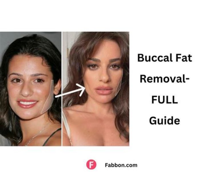 Exploring The Fascination Behind Buccal Fat Removal: The Olsen Twins’ Transformation