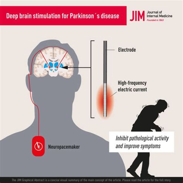 Julian McMahon and His Journey with Parkinson's Disease: Understanding the Impact and Awareness