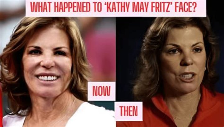 Kathy May Fritz Face Surgery: A Comprehensive Look at Her Transformation Journey