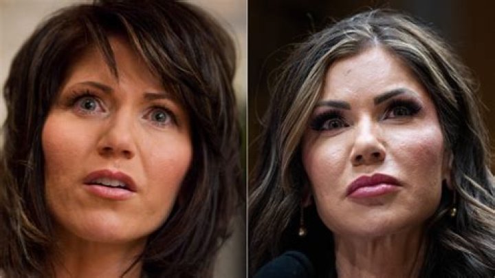 Kristi Noem Lips Before and After: A Comprehensive Look at the Transformation