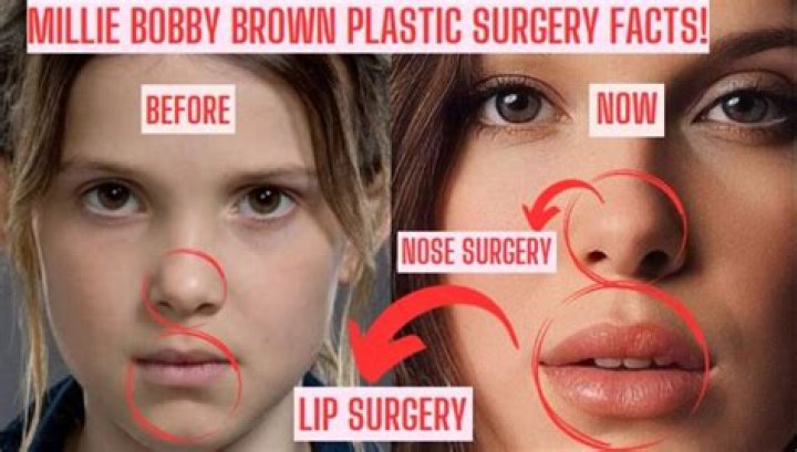 Millie Bobby Brown's Plastic Surgery Journey