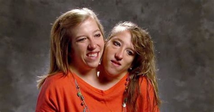 Miracle Of Life: Conjoined Twins Abby And Brittany Hensel Expecting Child