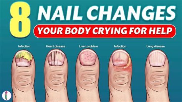 Ridged Fingernails Vitamin Deficiency: What You Need to Know