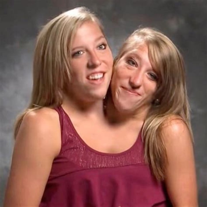 Tragic Loss: Conjoined Twins, Abby And Brittany, Succumb To Pregnancy Complications