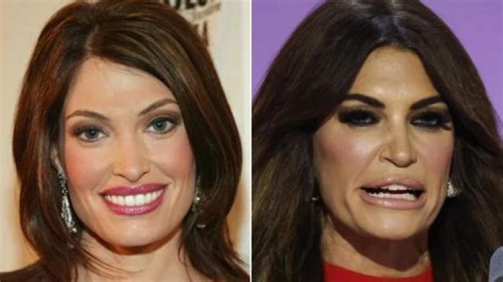 Transformations In The Spotlight: Kimberly Guilfoyle's Face Before And After