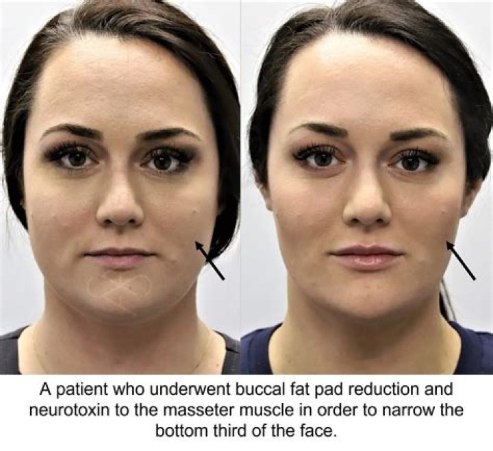 Unveiling Mary Kate Olsen's Buccal Fat Transformation