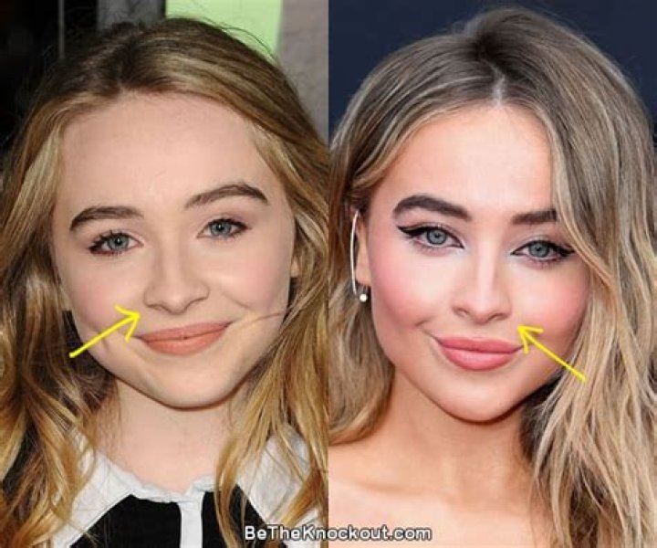 Unveiling The Truth: Does Sabrina Carpenter Have Lip Filler?