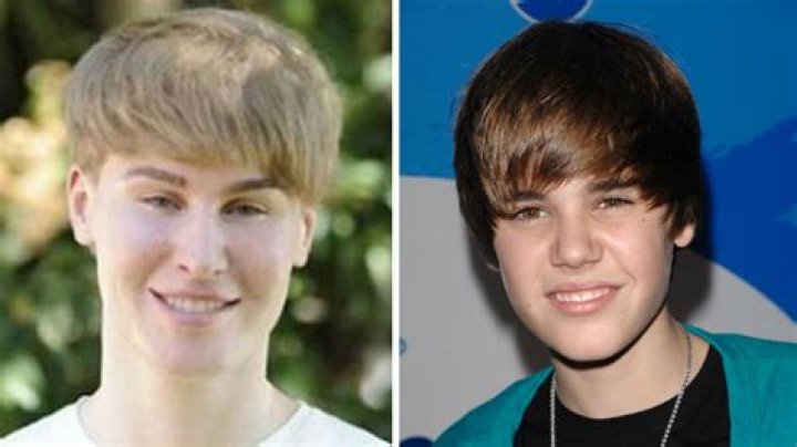 Unveiling The Truths Behind Justin Bieber's Botched Cosmetic Surgery
